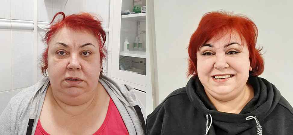 Блефаропластика - Фото до и после процедуры пластика век в клинике косметологии Effi в Красноярске. У пациента 5 сделана пластика круговая век