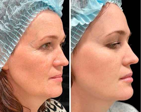 RF-лифтинг лица - фото до и после процедуры в клинике косметологии Effi в Красноярске. У пациента подтянулся овал лица и скулы, подтянулись морщинки у глаз