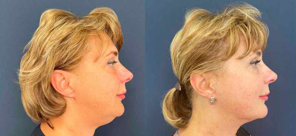 Лазерный липолиз подбородка - Фото до и после процедуры лазерного липолиза подбородка в клинике косметологии Effi в Красноярске. У пациента заметно корректировался контур лица, уменьшился второй подбородок