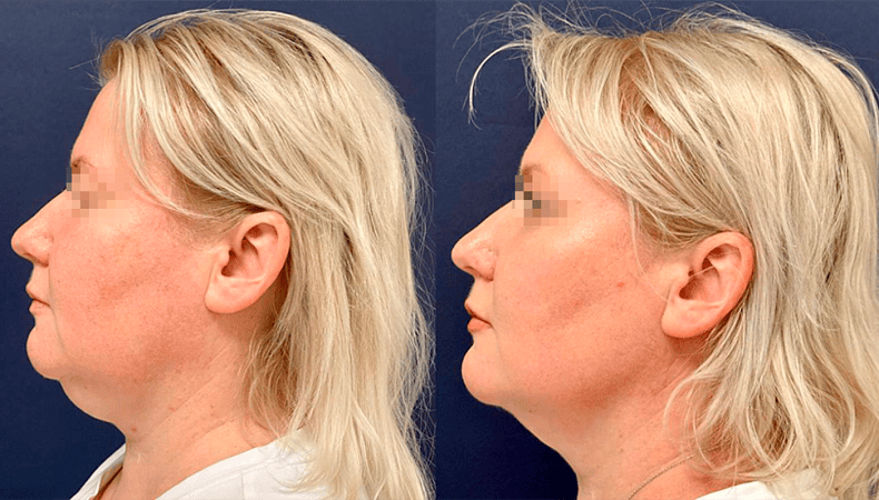 Лазерный липолиз подбородка - Фото до и после процедуры лазерного липолиза подбородка в клинике косметологии Effi в Красноярске. У пациента заметно после 1 процедуры подтянулся контур лица, лицо стало более подтянутым