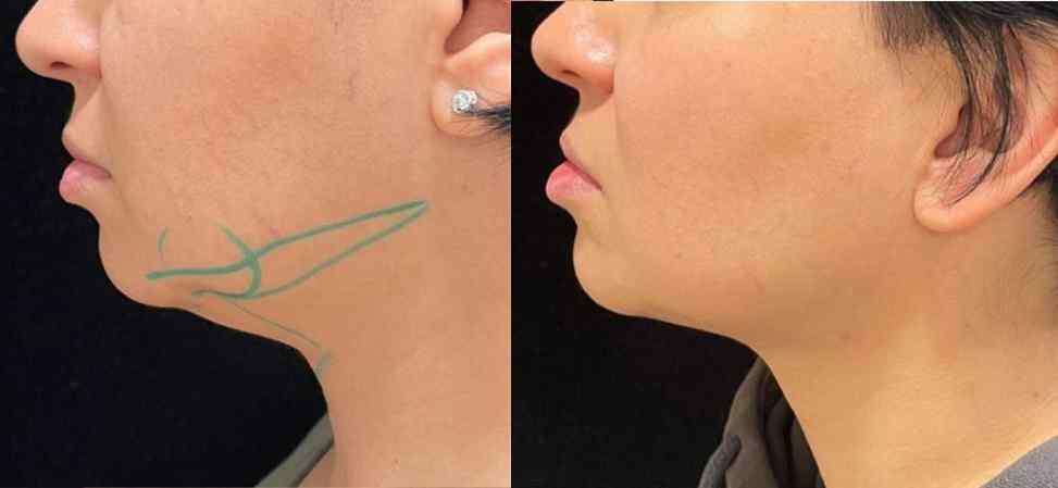 Лазерный липолиз подбородка - Фото до и после процедуры лазерного липолиза подбородка в клинике косметологии Effi в Красноярске. У пациента заметно ушел второй подбородок, лицо стало более худым