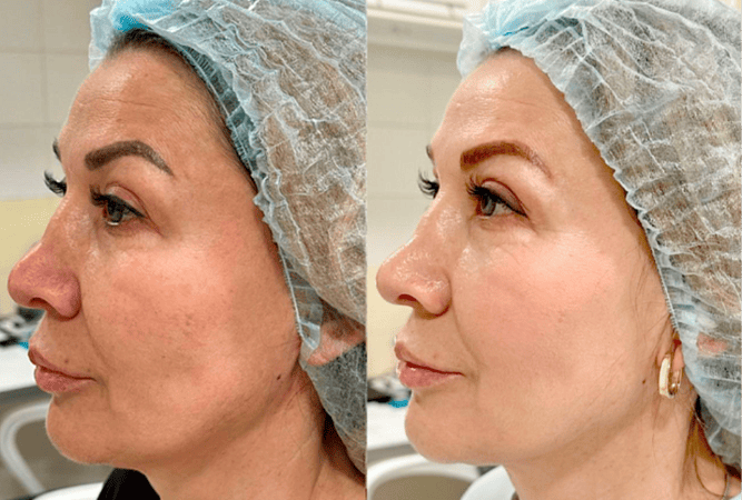 RF-лифтинг лица - фото до и после процедуры в клинике косметологии Effi в Красноярске. Овал лица стал более четкий, кожа подтянулась, подбородок стал более четкий