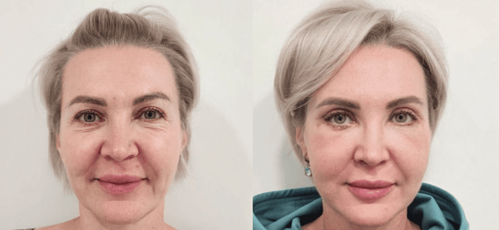 Игольчатый rf лифтинг - Фото лица до и после процедуры в клинике Еffi в Красноярске. На пациенте видно, что морщины подтянулись, лицо выглядит молодым. Наши врачи имеют большой опыт работы в этой области постоянно совершенствуются повышением квалификации.
