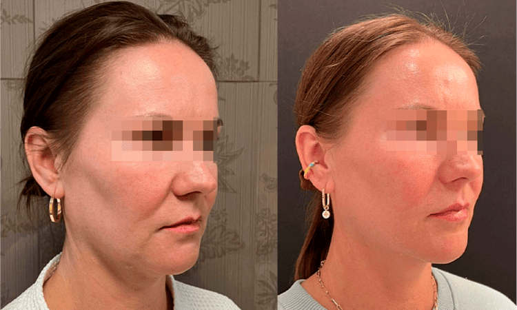 RF-лифтинг лица - фото до и после процедуры в клинике косметологии Effi в Красноярске. У пациентки овал лица стал более четкий