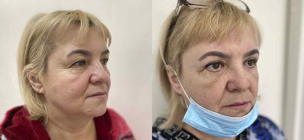Блефаропластика - Фото до и после процедуры пластика век в клинике косметологии Effi в Красноярске. У пациента 9 сделана пластика верхних век