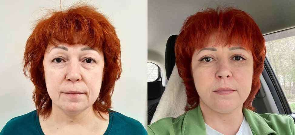 Блефаропластика - Фото до и после процедуры пластика век в клинике косметологии Effi в Красноярске. У пациента 14