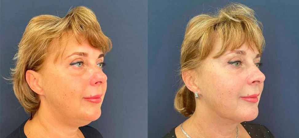 Лазерный липолиз подбородка - Фото до и после процедуры лазерного липолиза подбородка в клинике косметологии Effi в Красноярске. У пациента заметно корректировался контур лица