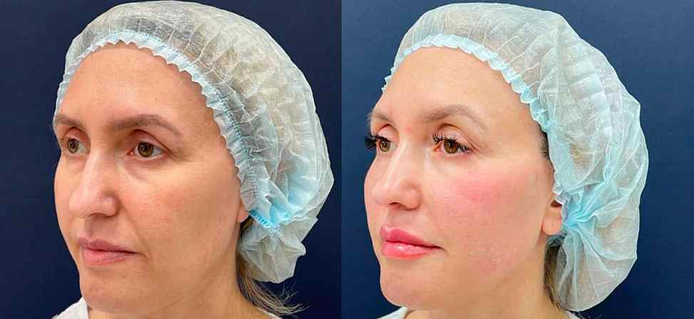 Игольчатый rf лифтинг - Фото лица женщины с боку до и после процедуры в клинике Еffi в Красноярске. На пациенте видно, что морщины подтянулись. Наши врачи имеют большой опыт работы в этой области постоянно совершенствуются повышением квалификации.