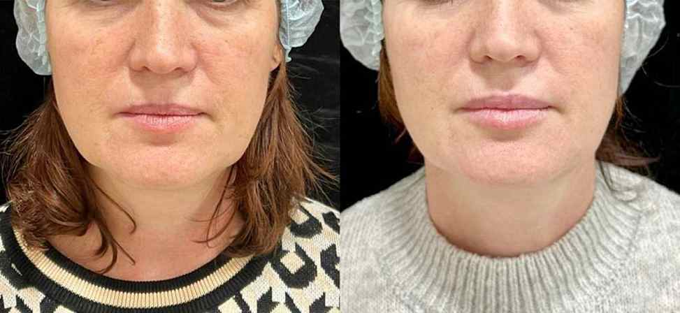 RF-лифтинг лица - Фото лица женщины до и после процедуры игольчатого rf лифтинга в клинике Еffi в Красноярске. На пациенте видно, что контур лица стал более четким, морщины подтянулись. Наши врачи имеют большой опыт работы в этой области постоянно соверше