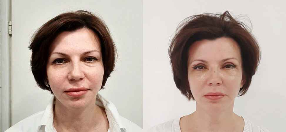 Блефаропластика - Фото до и после процедуры пластика век в клинике косметологии Effi в Красноярске. У пациента 19