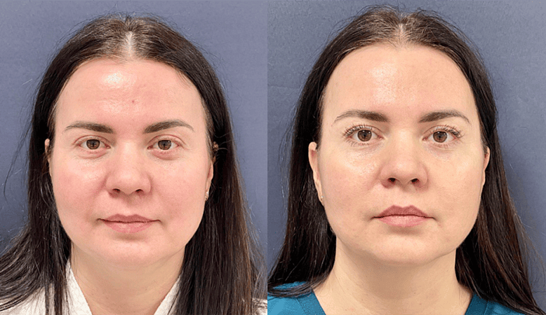 Лазерный липолиз подбородка - Фото до и после процедуры лазерного липолиза подбородка в клинике косметологии Effi в Красноярске. У пациента заметно после 1 процедуры подтянулся контур лица