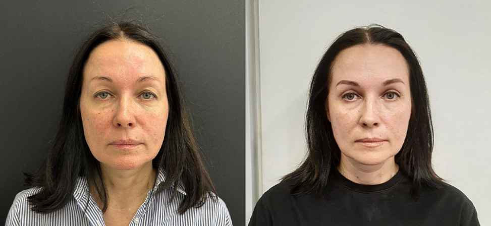 Блефаропластика - Фото до и после процедуры пластика век в клинике косметологии Effi в Красноярске. У пациента 18