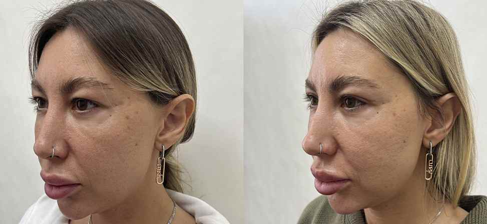 Блефаропластика - Фото до и после процедуры пластика век в клинике косметологии Effi в Красноярске. У пациента 6 сделана пластика верхних век (вид с боку)