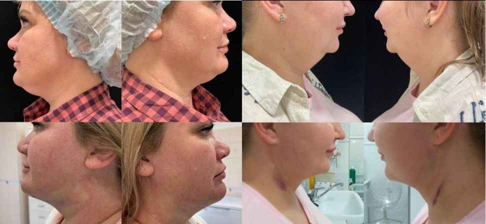 Лазерный липолиз подбородка - Фото до и после процедуры лазерного липолиза подбородка в клинике косметологии Effi в Красноярске. У пациента заметно ушел второй подбородок