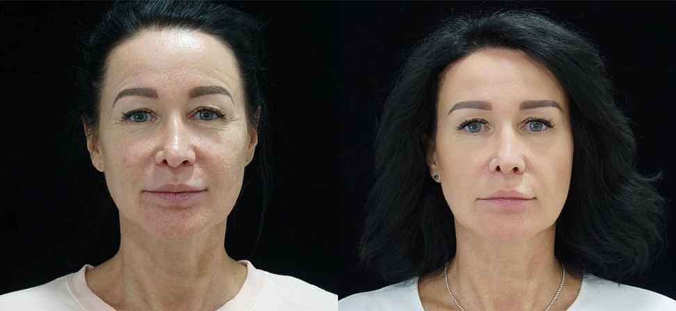 Игольчатый rf лифтинг - Фото лица с боку до и после процедуры в клинике Еffi в Красноярске. На пациенте видно, что лицо стало более молодым. Наши врачи имеют большой опыт работы в этой области постоянно совершенствуются повышением квалификации.