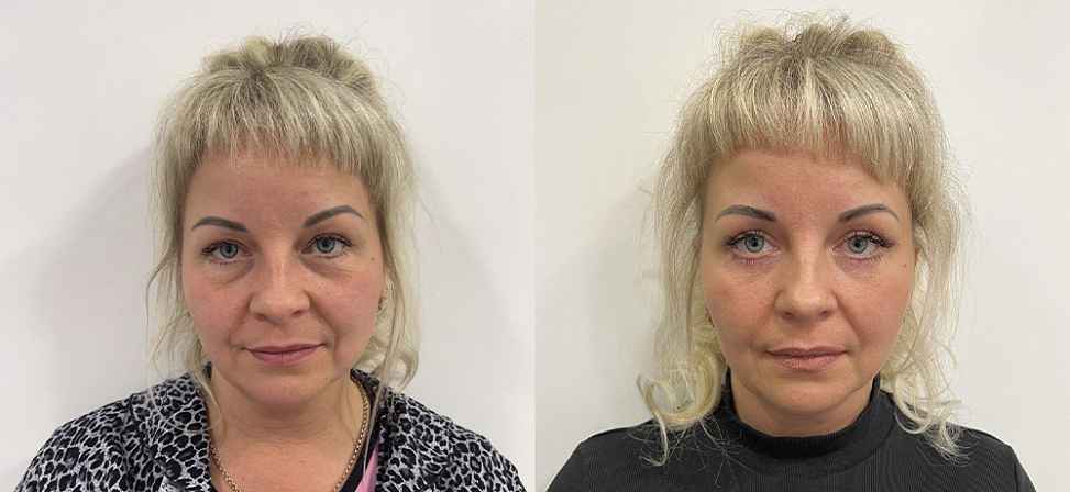 Блефаропластика - Фото до и после процедуры пластика век в клинике косметологии Effi в Красноярске. У пациента 12