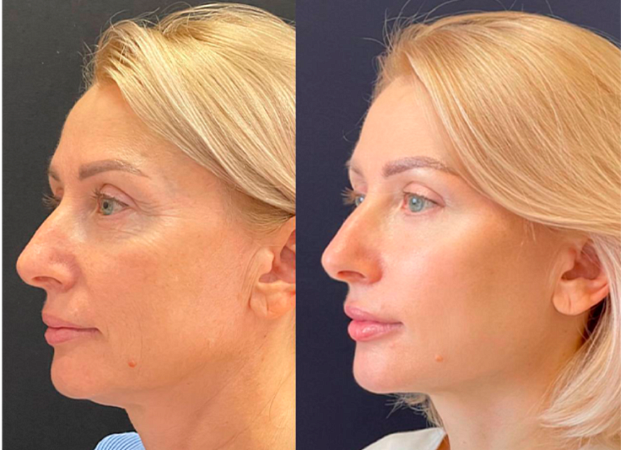 RF-лифтинг лица - фото до и после процедуры в клинике косметологии Effi в Красноярске. У пациента подтянулся овал лица и скулы, подтянулись морщинки у глаз, тон лица выровнялся