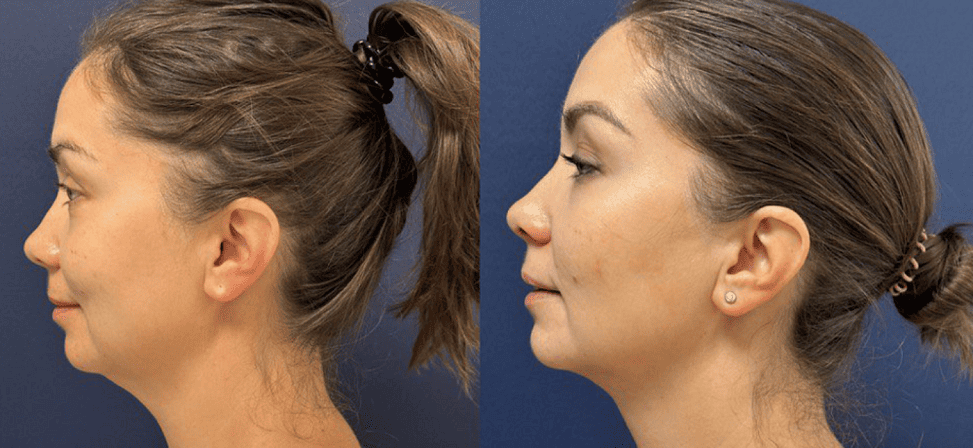 Лазерный липолиз подбородка - Фото до и после процедуры лазерного липолиза подбородка в клинике косметологии Effi в Красноярске. У пациента после 1 процедуры подтянулся контур лица, на вид стало более подтянутым