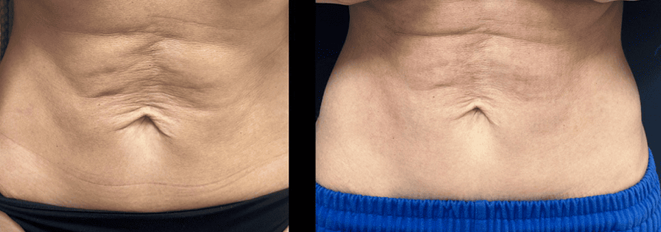 Игольчатый rf лифтинг - Фото живота до и после процедуры в клинике Еffi в Красноярске. На пациенте видно, что растяжки ушли. Наши врачи имеют большой опыт работы в этой области постоянно совершенствуются повышением квалификации.