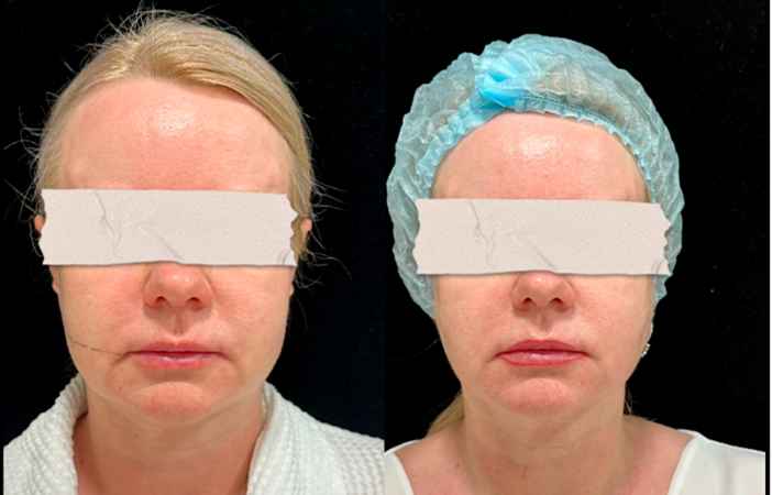 RF-лифтинг лица - фото до и после процедуры в клинике косметологии Effi в Красноярске. У пациентки овал лица стал более четкий, подтянулись морщинки, скулы более четкие