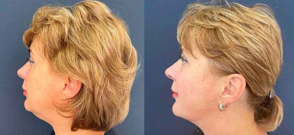 Лазерный липолиз подбородка - Фото до и после процедуры лазерного липолиза подбородка в клинике косметологии Effi в Красноярске. У пациента заметно корректировался контур лица, уменьшился второй подбородок вид с боку