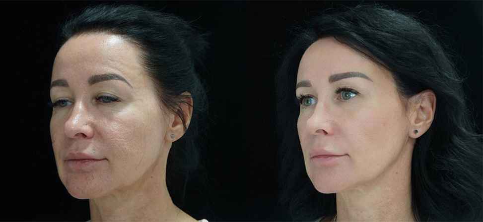 Игольчатый rf лифтинг лица - Фото лица с боку до и после процедуры в клинике Еffi в Красноярске. На пациенте видно, что лицо стало более молодым. Наши врачи имеют большой опыт работы в этой области постоянно совершенствуются повышением квалификации.