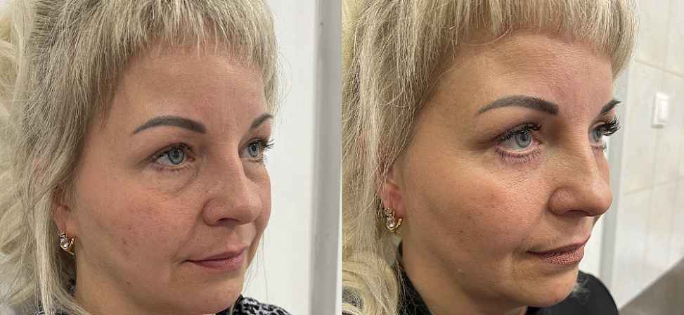 Блефаропластика - Фото до и после процедуры пластика век в клинике косметологии Effi в Красноярске. У пациента 12 сделана пластика верхних век