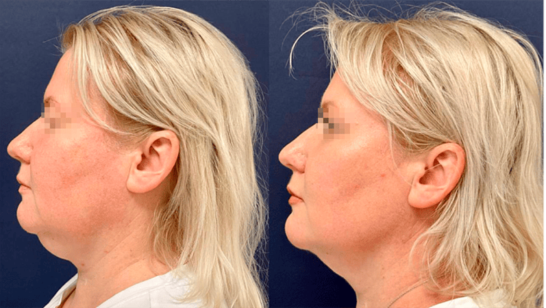 RF-лифтинг лица - фото до и после процедуры в клинике косметологии Effi в Красноярске. У пациентки овал лица стал более четкий, тон более ровный, подтянулись морщинки