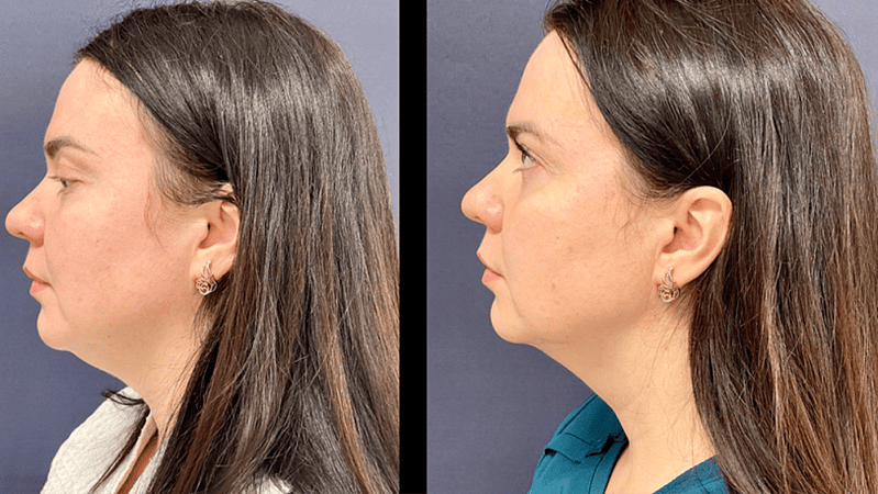 Лазерный липолиз подбородка - Фото до и после процедуры лазерного липолиза подбородка в клинике косметологии Effi в Красноярске. У пациента заметно после 1 процедуры подтянулся контур лица, уменьшилась жировая прослойка (вид с боку)