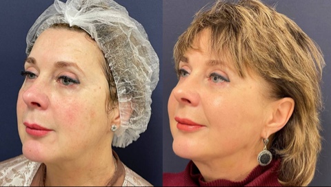 Игольчатый rf лифтинг лица - Фото до и после процедуры в клинике Еffi в Красноярске. У пациента заметно  стал более четким контур лица, выровнялся тон кожи